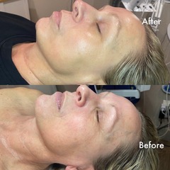 Before and after facial skincare treatment