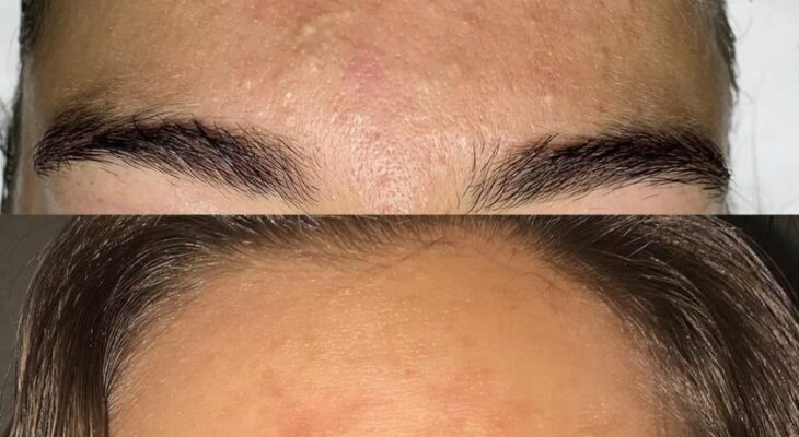 Before and after facial skincare treatment